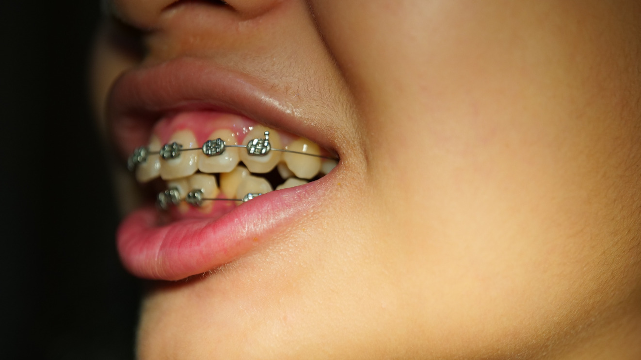orthodontics braces aligner